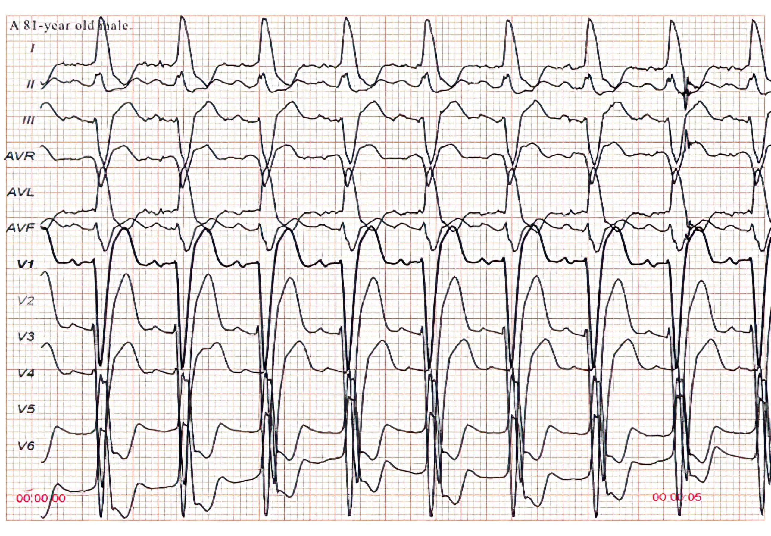 81-year-old man incomplete LBBB ECG.
