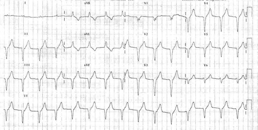 Accelerated idioventricular rhythm ECG.