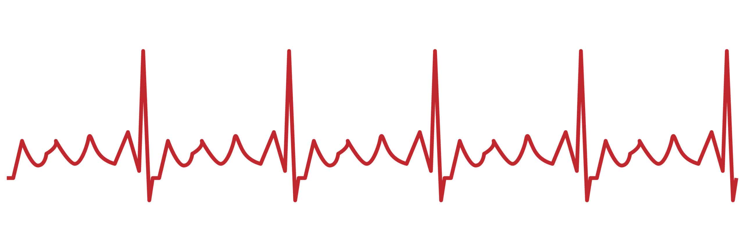 Atrial flutter “saw-tooth” on ECG.