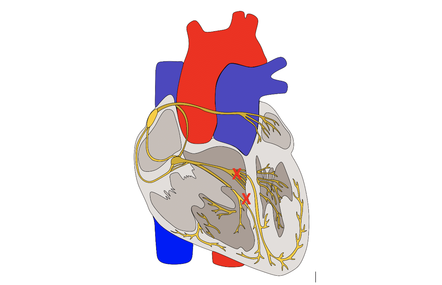 Bilateral bifascicular block of the RBBB + LPFB type.