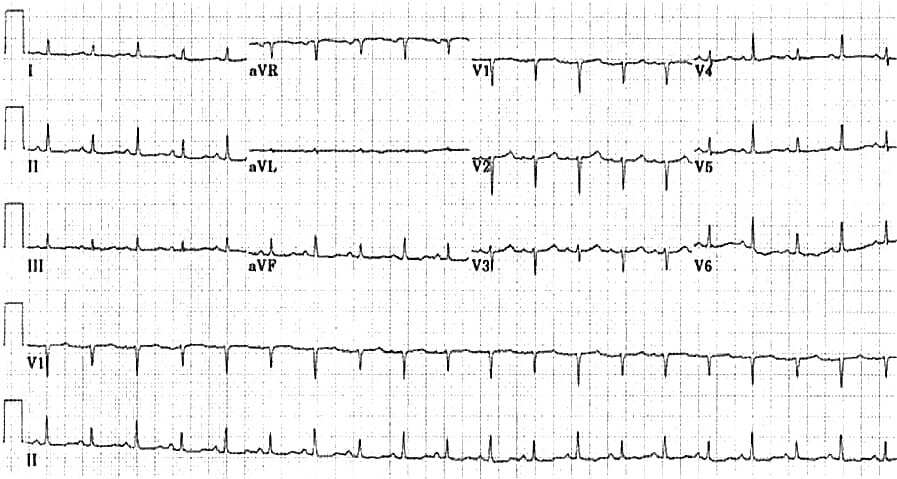 Cardiac tamponade electrical alternans.