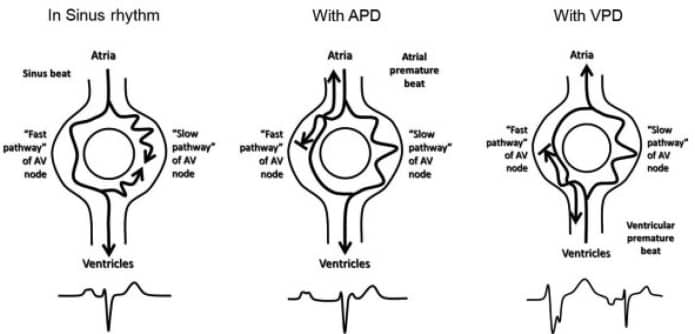 Dual AV nodal pathway physiology in sinus rhythm.