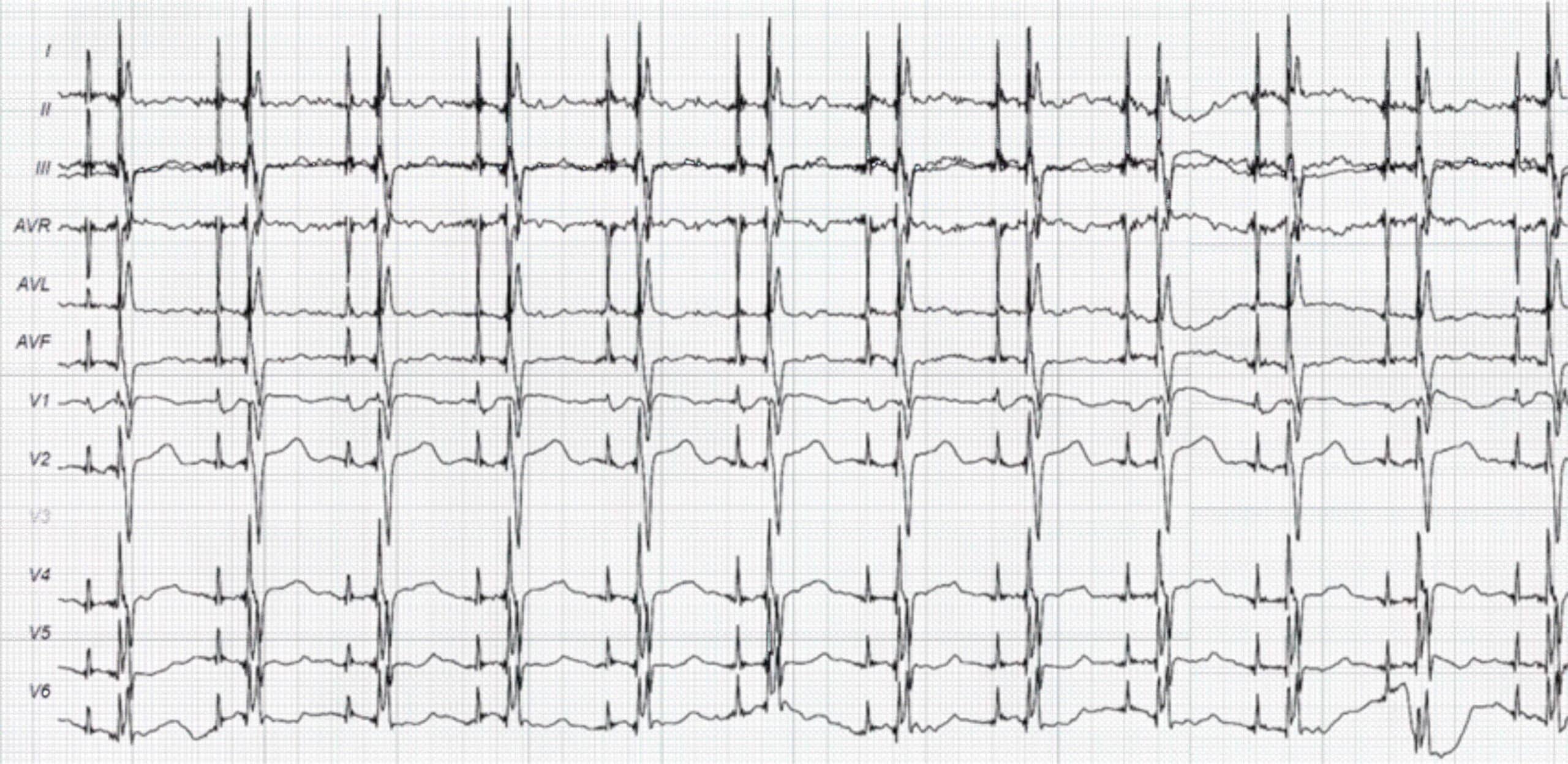 Dual-chamber pacing ECG rhythms.