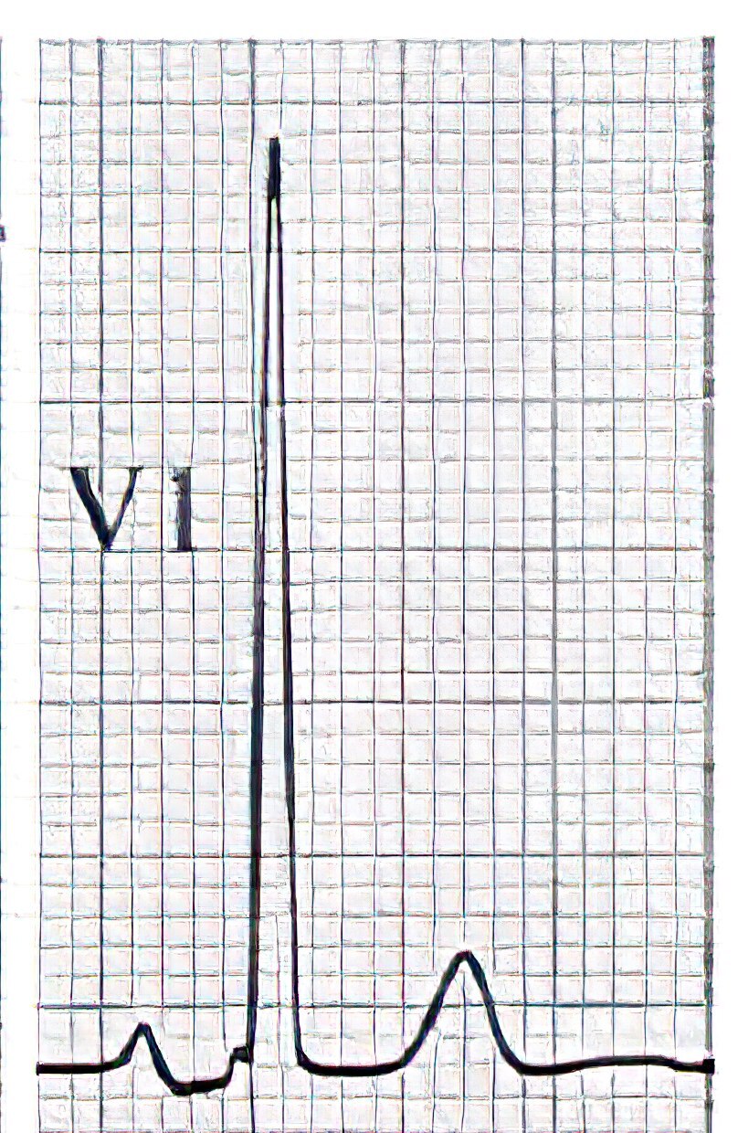 ECG tracing of 22-year-old man with large VSD.