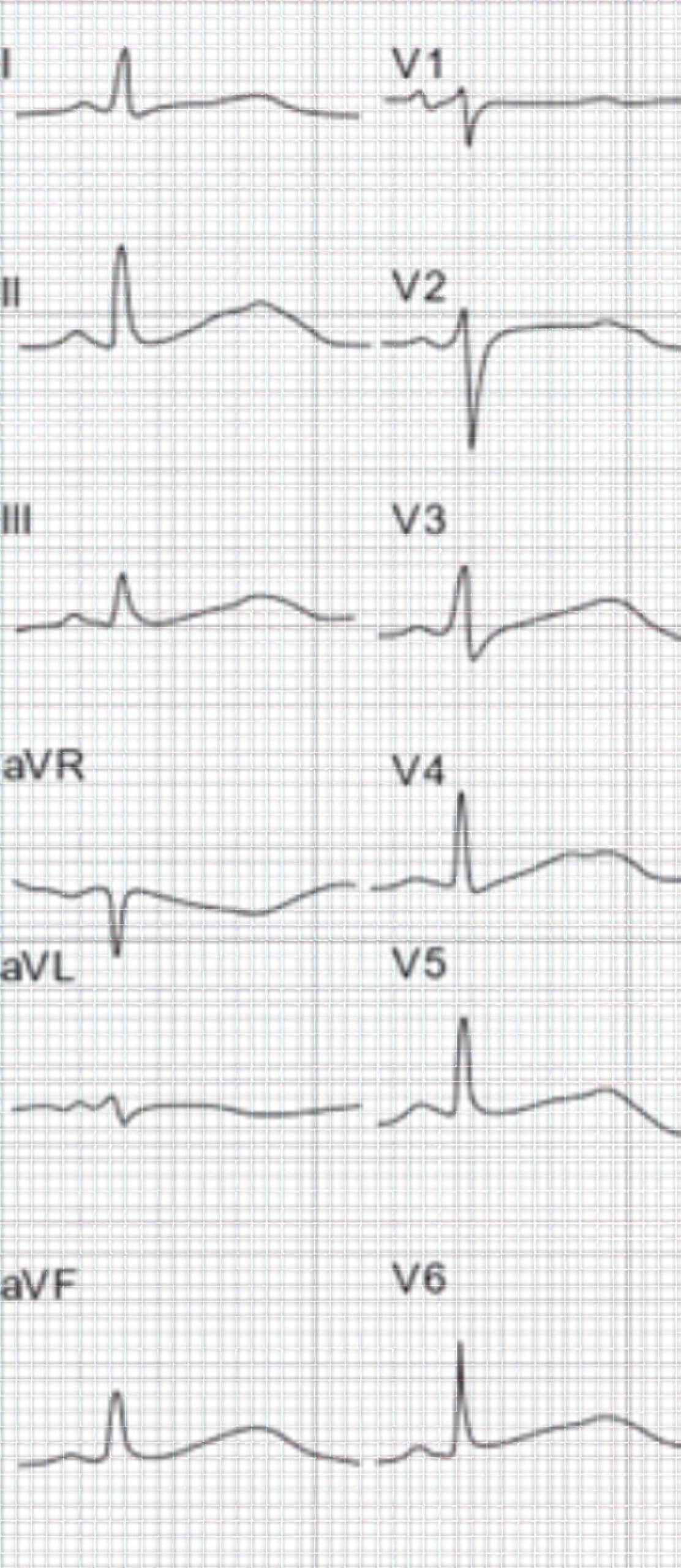 ECG depicts complete fusion of TU waves.