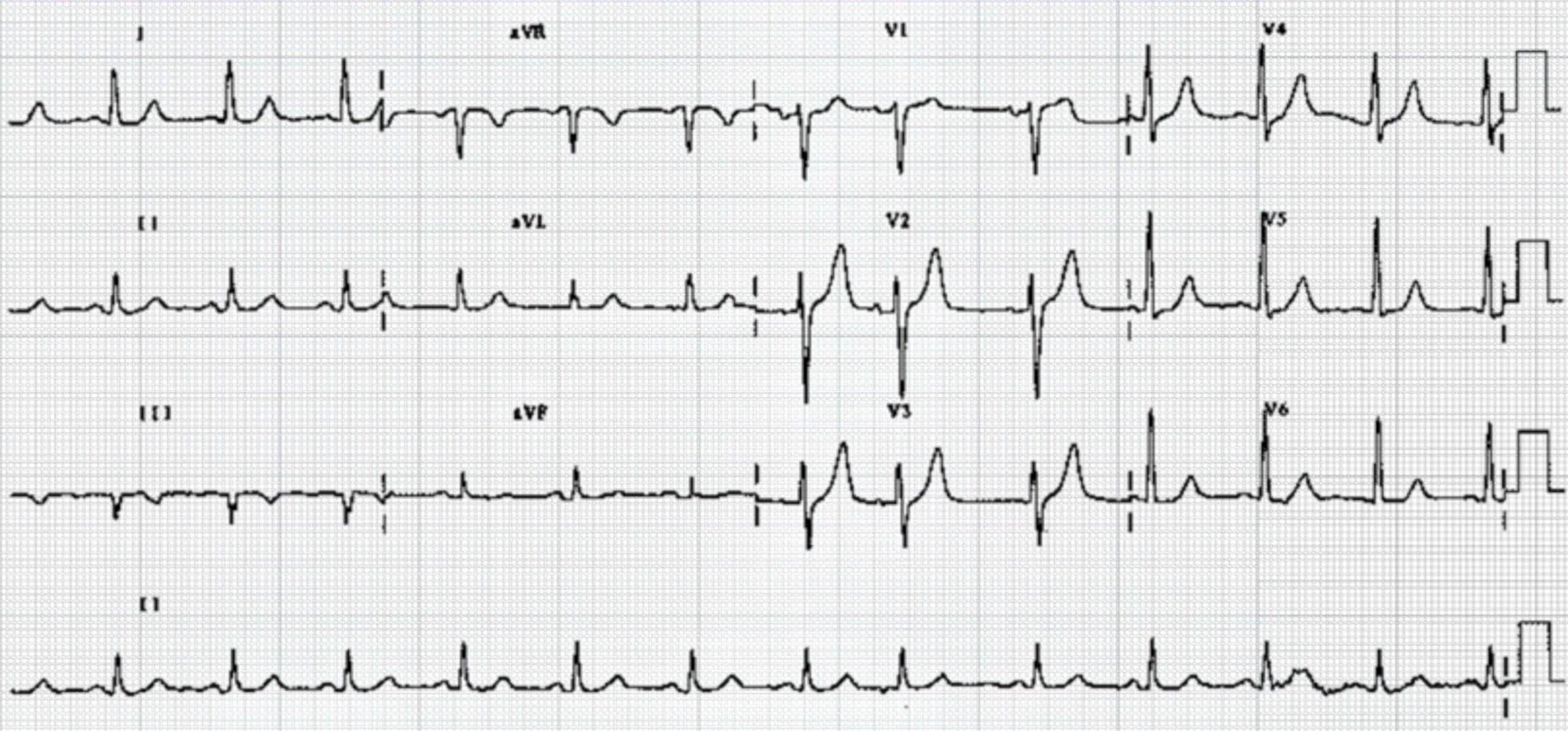 ECG with PACs.