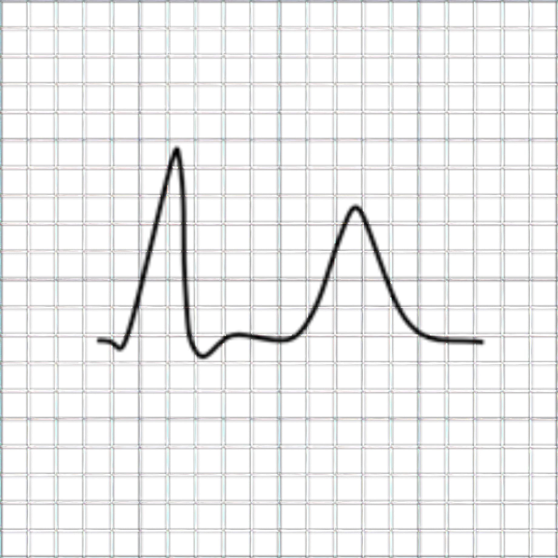 ECG tracing depicting subendocardial ischemia.
