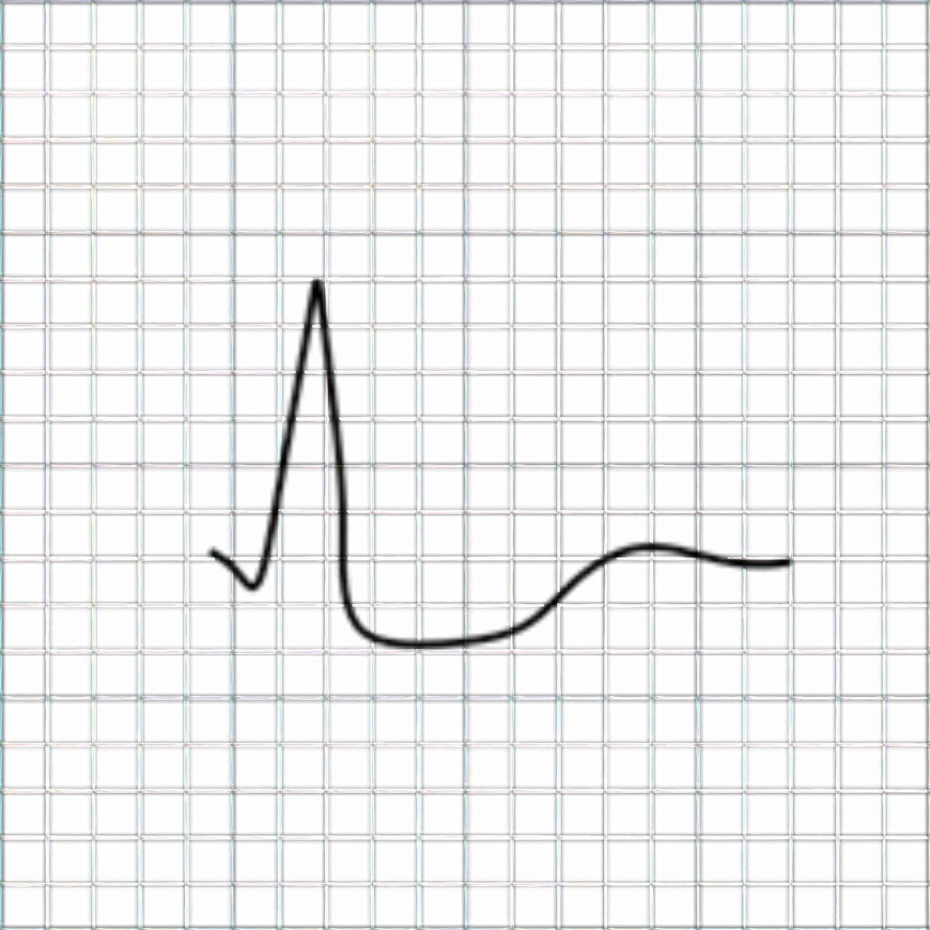 ECG tracing depicting subendocardial lesion.