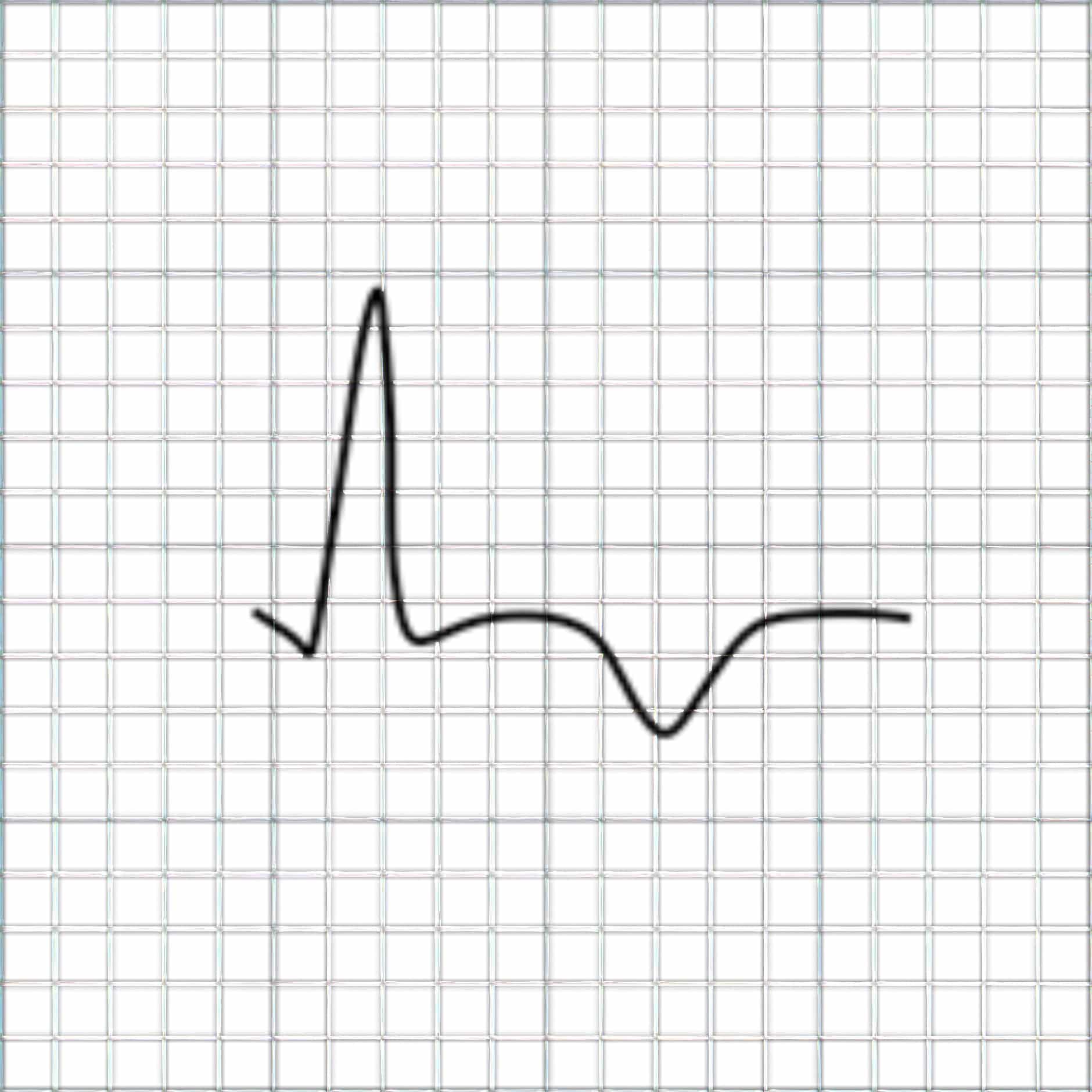 ECG tracing depicting subepicardial ischemia.