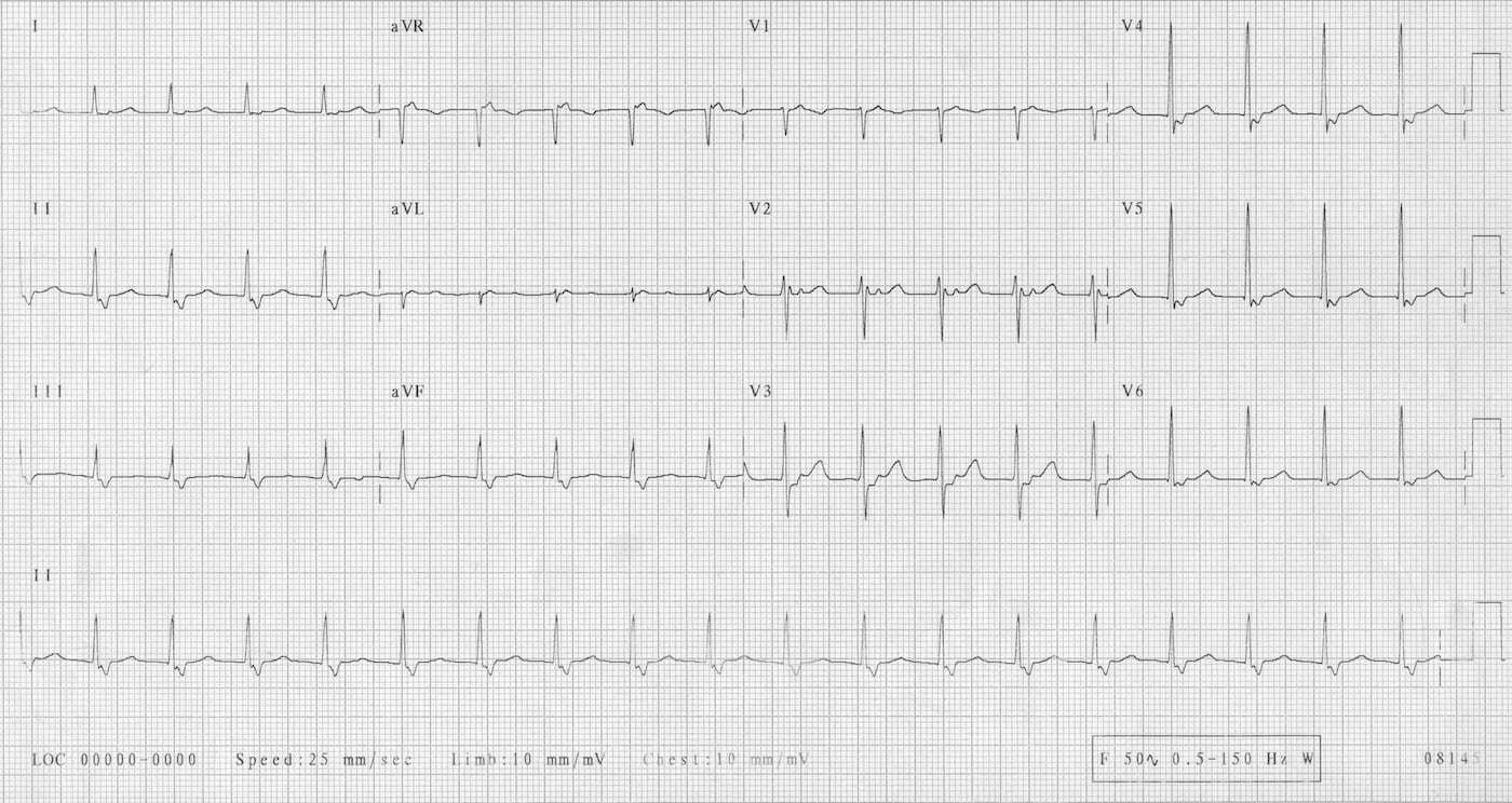 ECG representing typical fast-slow AVNRT.