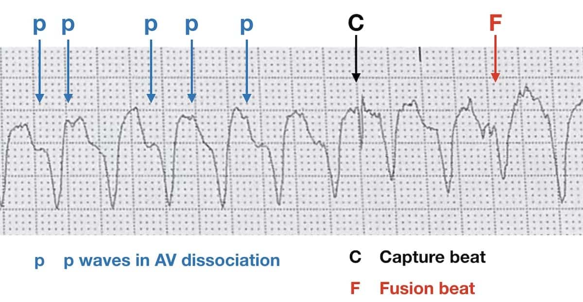 Fusion Complexes and Capture Beats.