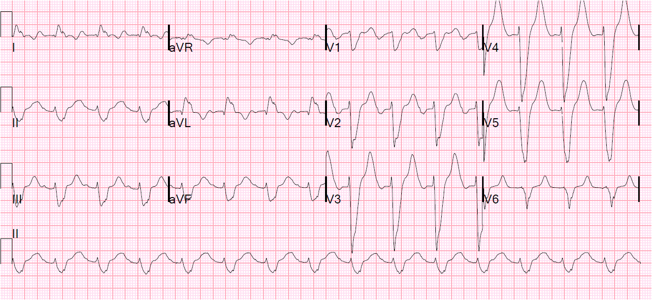 Hyperkalemia QRS duration ECG.