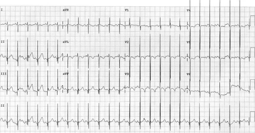 Katz-Watchel phenomenon ECG.