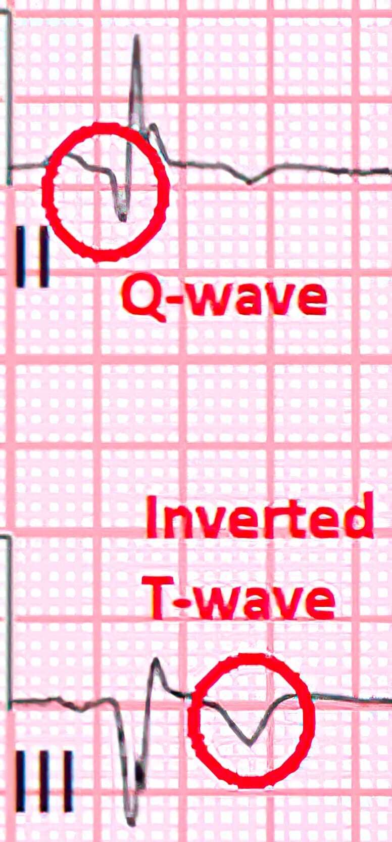 Myocardial infarction with Q and T waves.