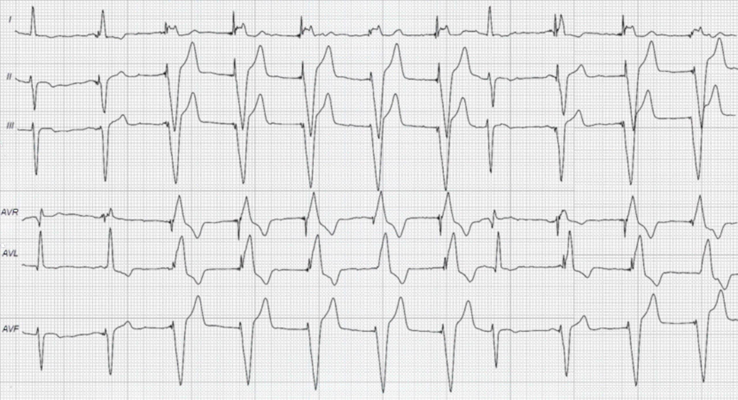 One-chamber ventricular-paced rhythm with two spontaneous beats