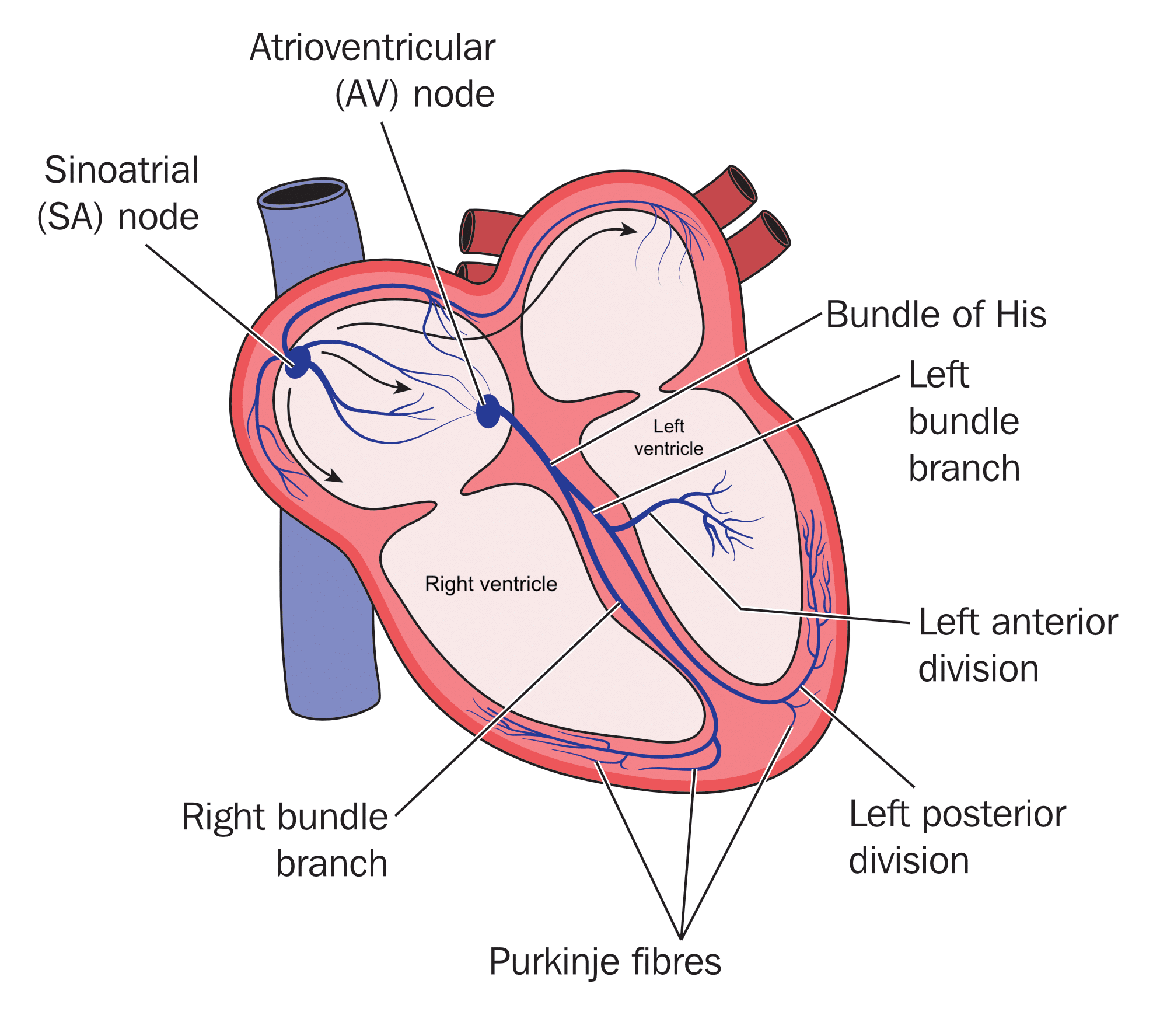 Premature ventricular contraction.
