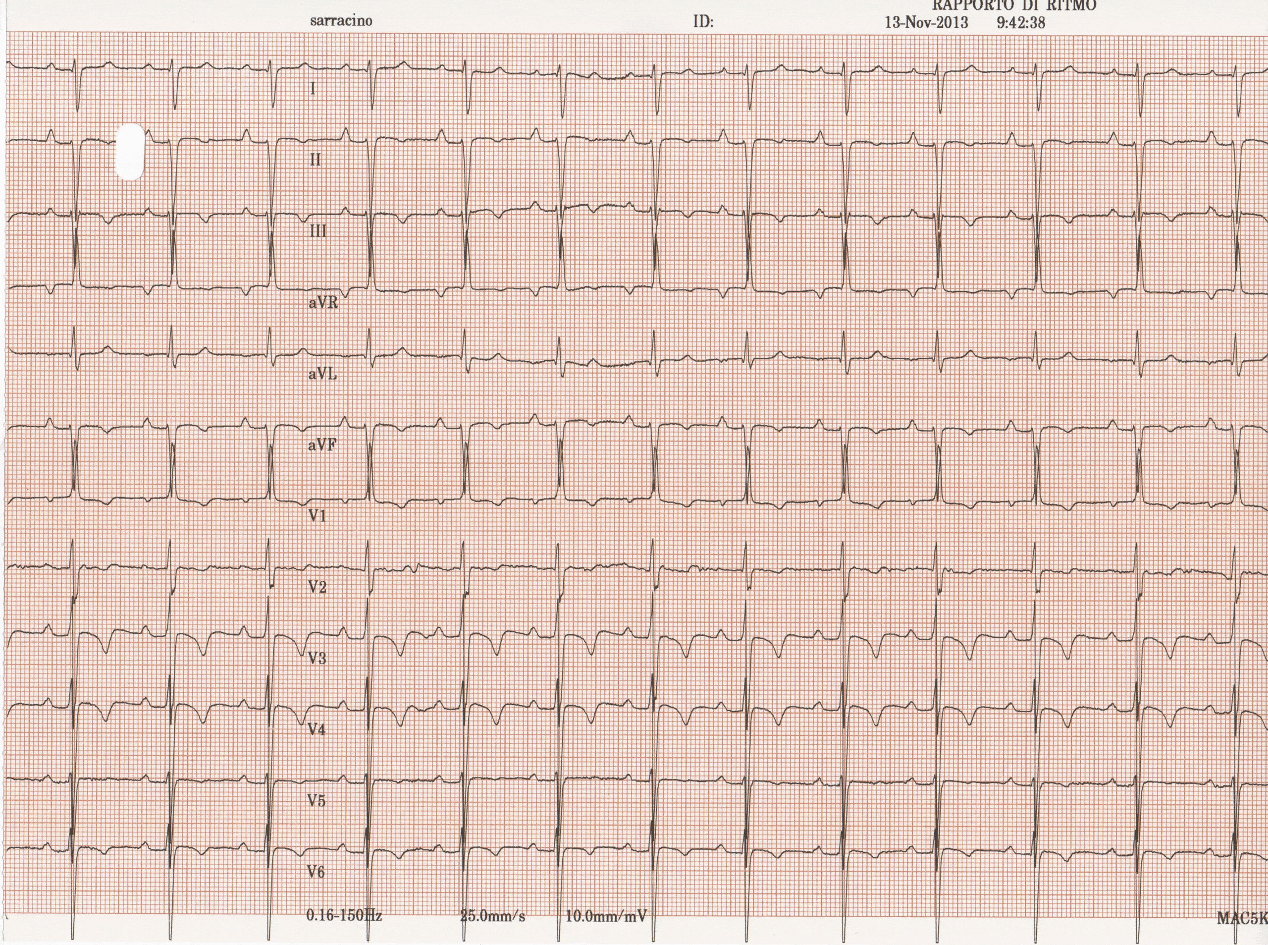 Pulmonary artery hypertension secondary to Eisenmenger syndrome ECG.