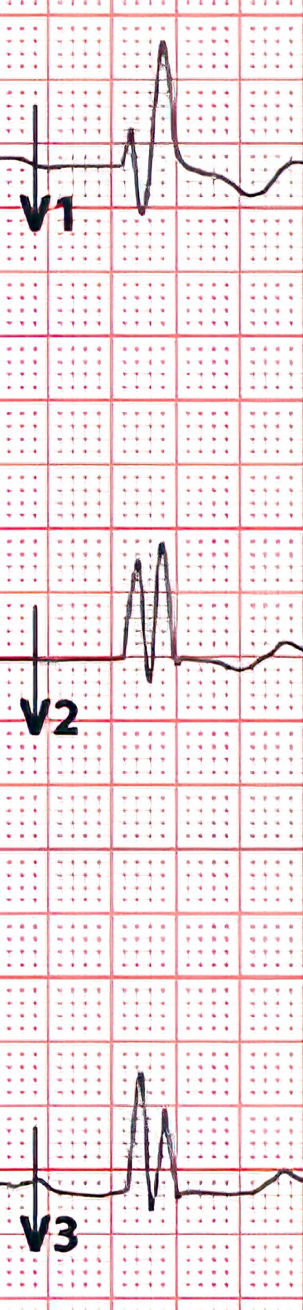 Right bundle branch block RSR pattern.