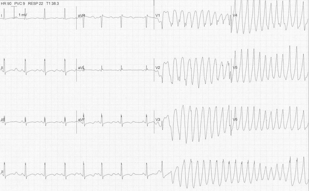 Severe hypokalemia ECG Rhythms.