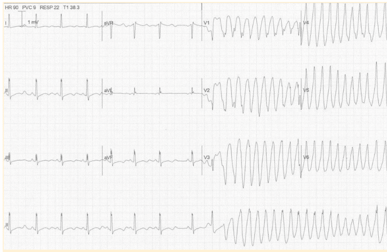 Torsades de Pointes secondary to hypokalemia ECG.