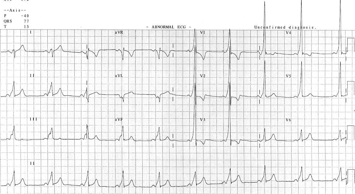 Type A Wolff-Parkinson-White syndrome ECG.