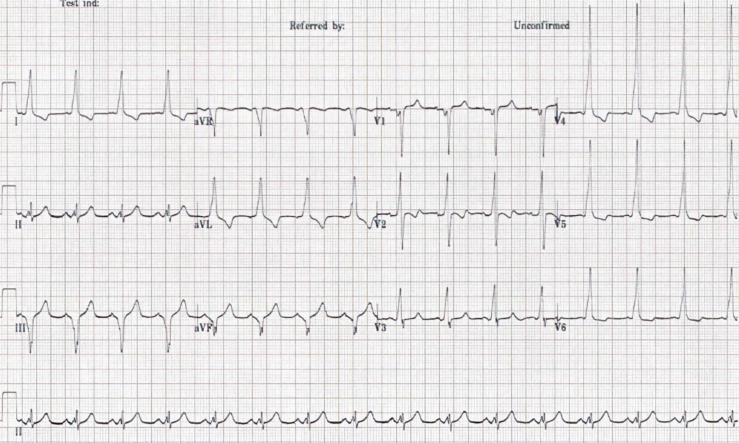 Type B WPW syndrome ECG.