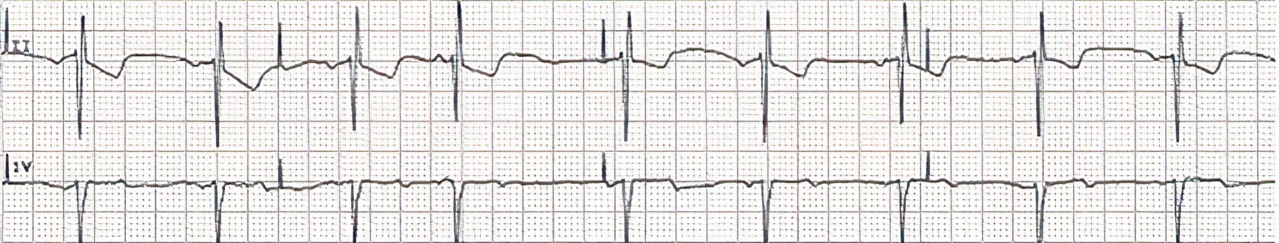 Undersensing pacemaker rhythm.