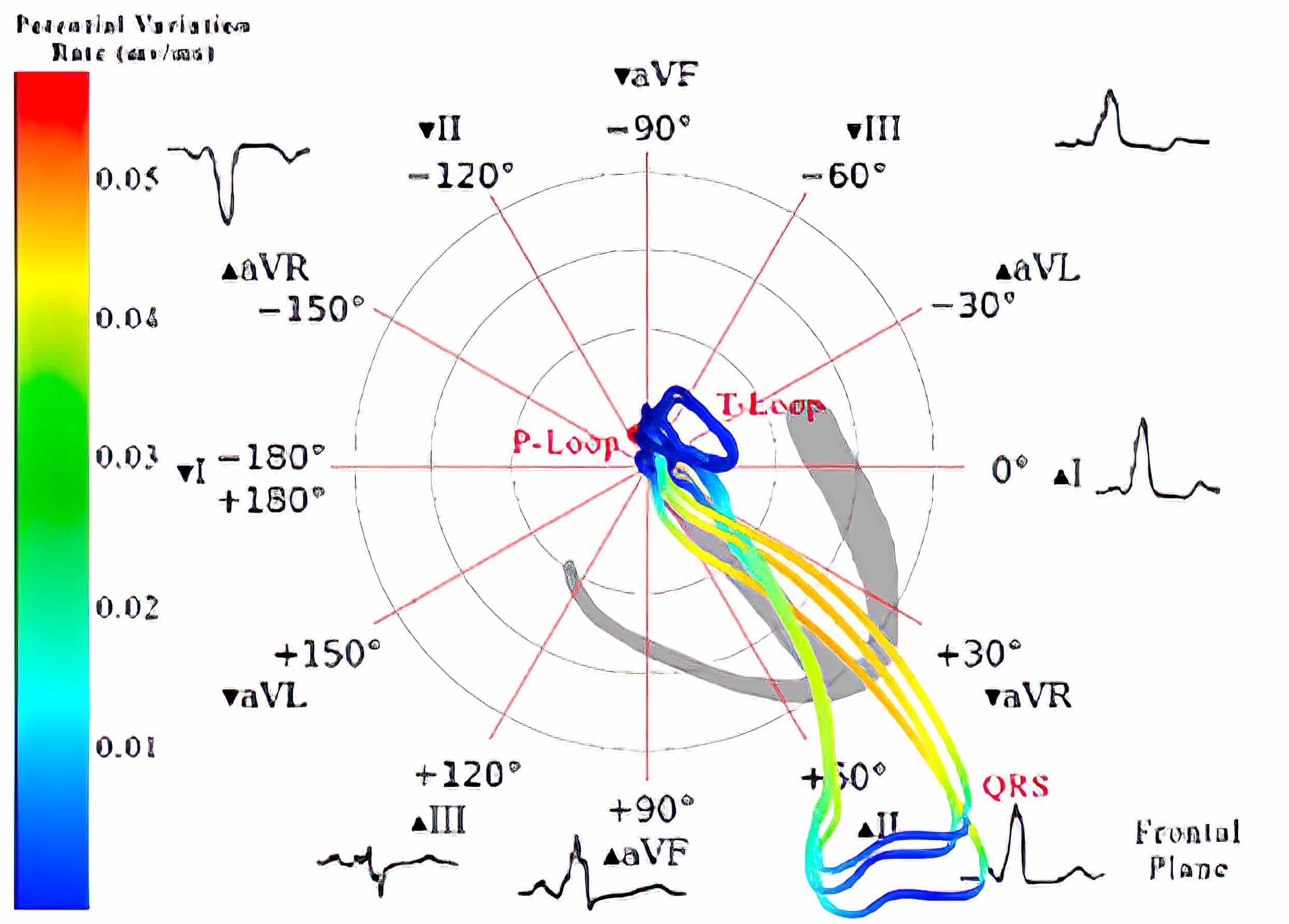 Vectorcardiograph (frontal plane) and electrocardiograph of complete LBBB and normal.