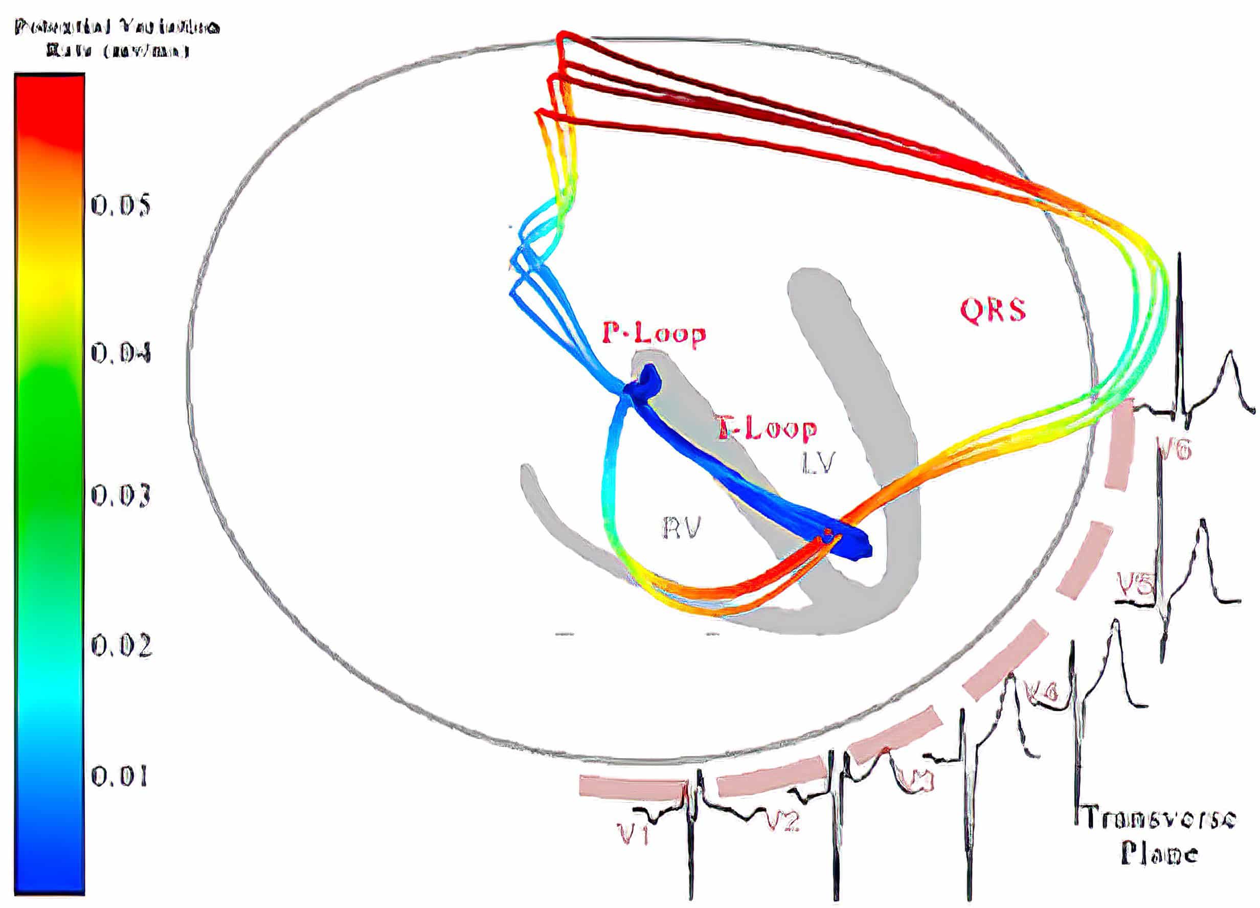 Vectorcardiograph (transverse plane) and electrocardiograph of complete LBBB and normal.
