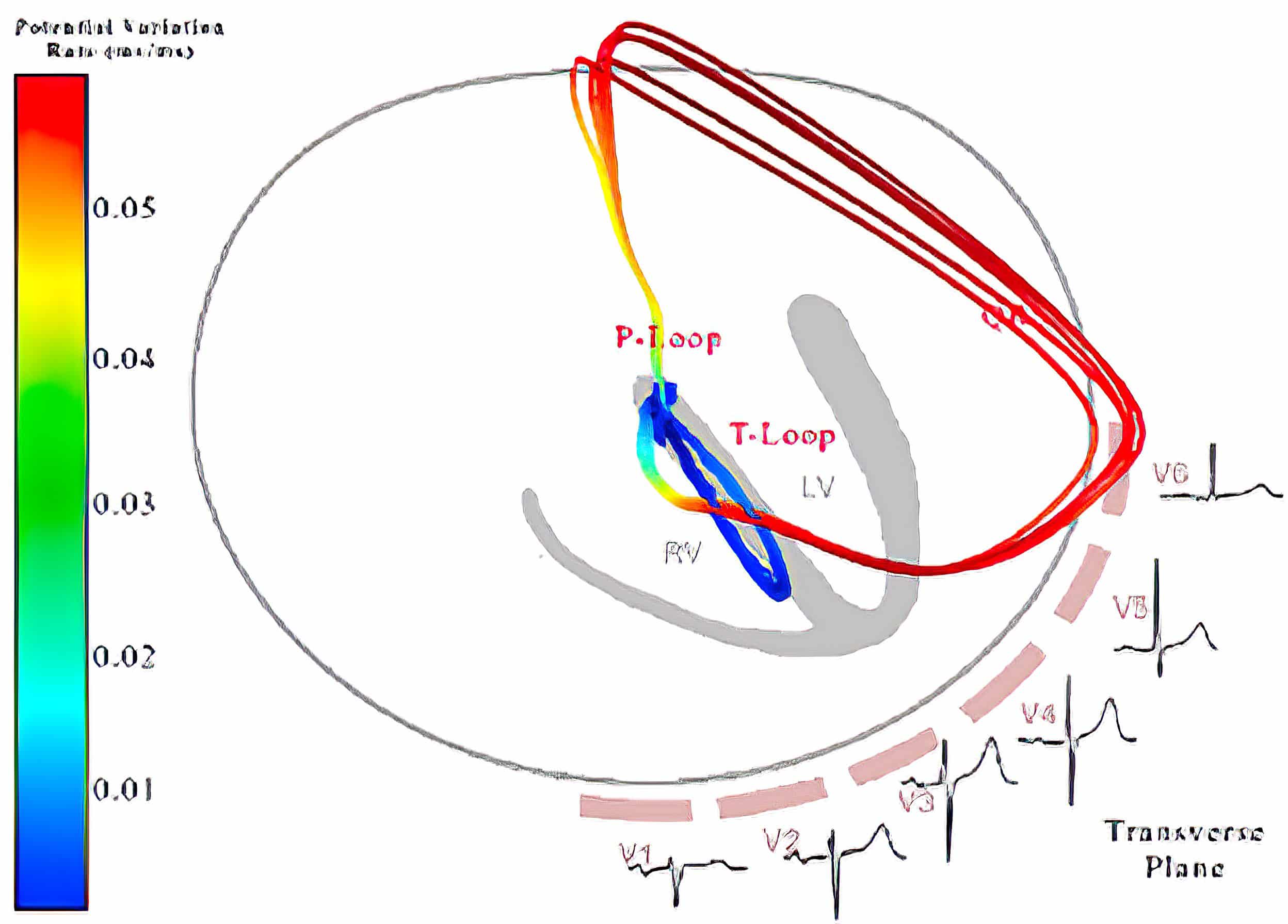 Vectorcardiograph (transverse plane) and electrocardiograph of complete LBBB and normal.