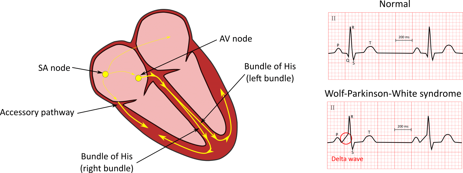 Wolff-Parkinson-White syndrome.