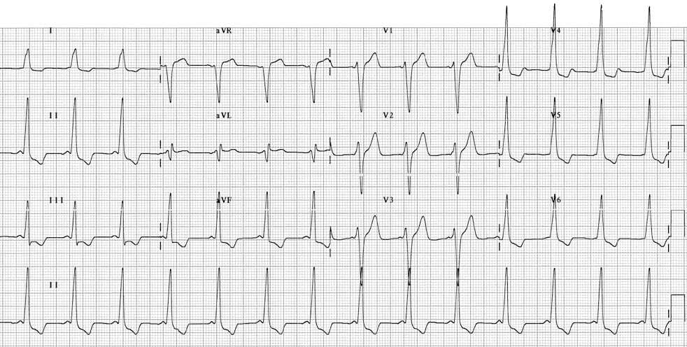 Wolff-Parkinson-White syndrome type B ECG.