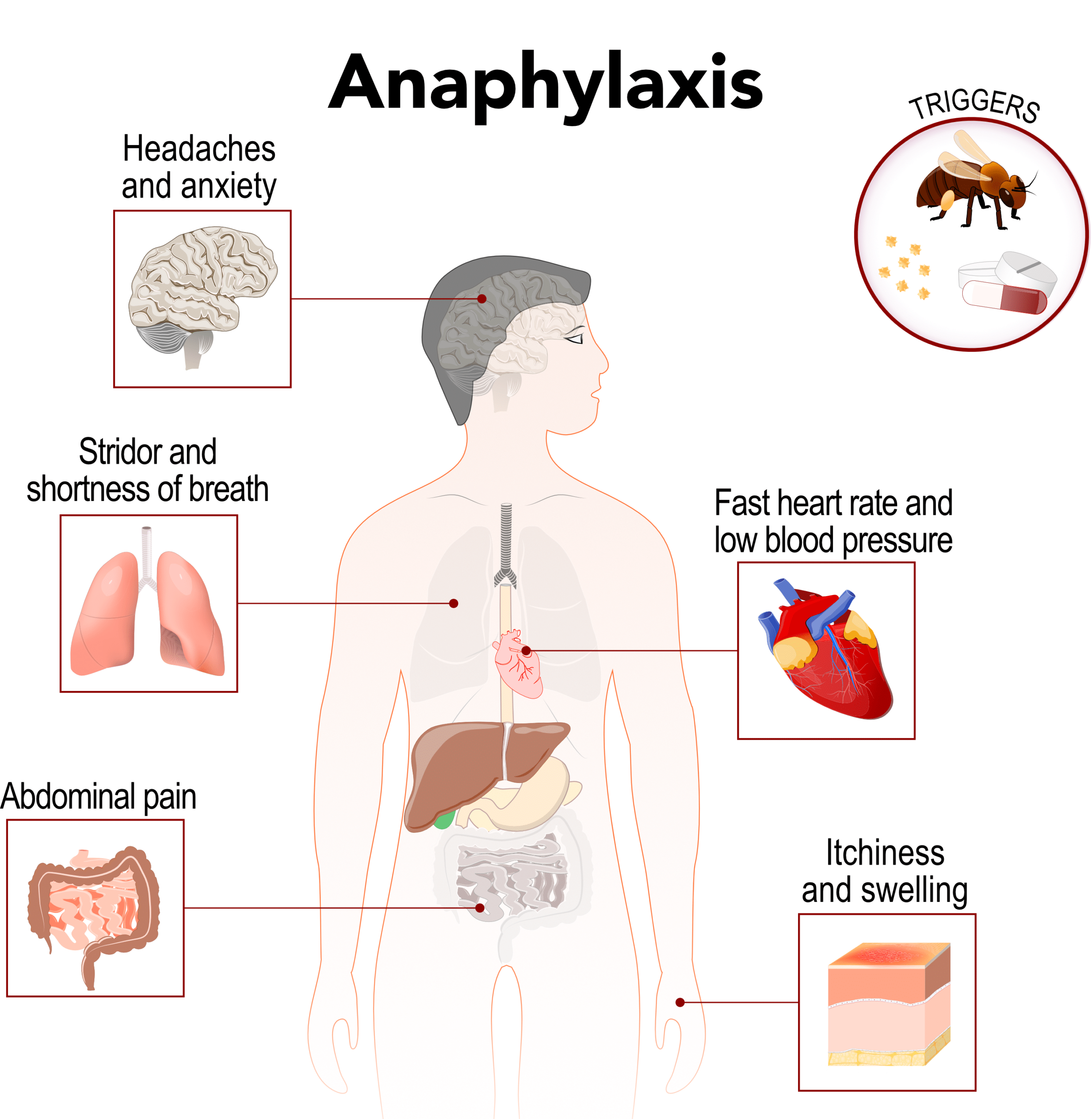Anaphylaxis signs and symptoms.