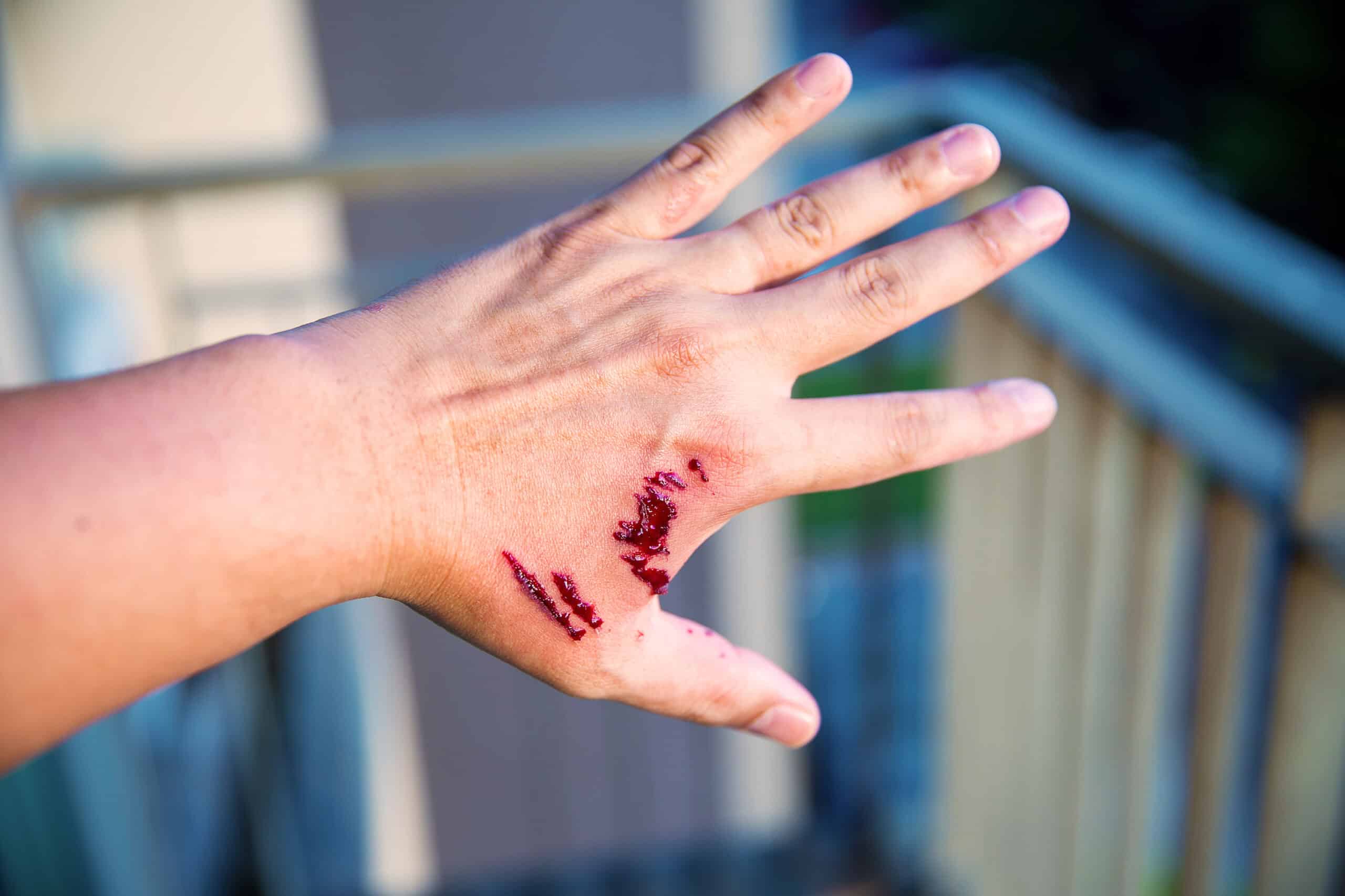 Dog bite wound.