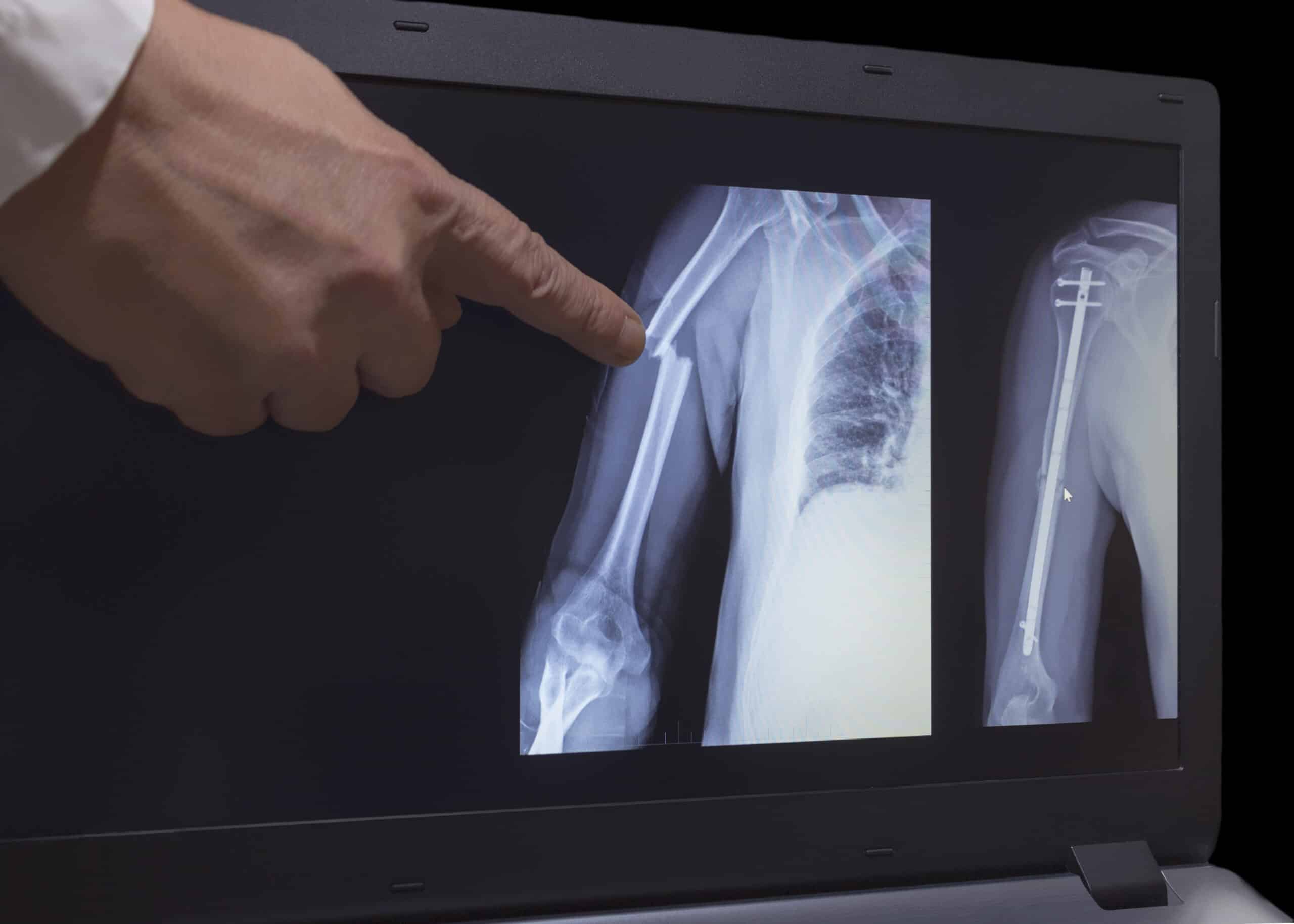 Examining upper arm fracture x-ray.