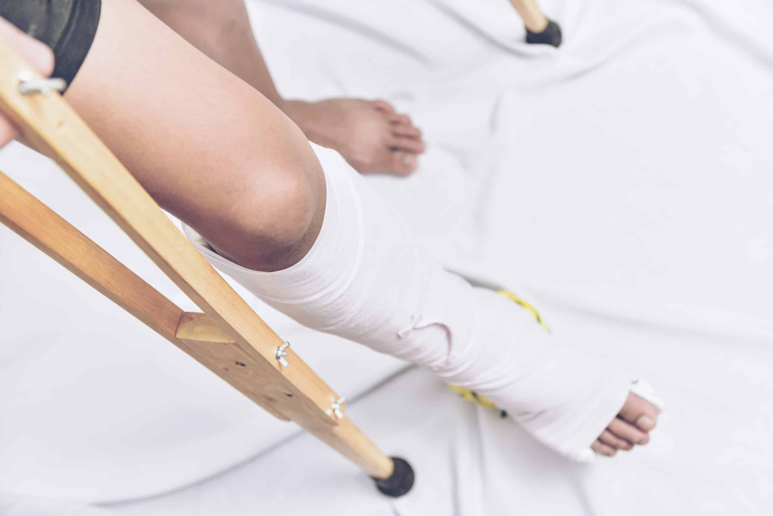 Fractured lower extremity in splint.