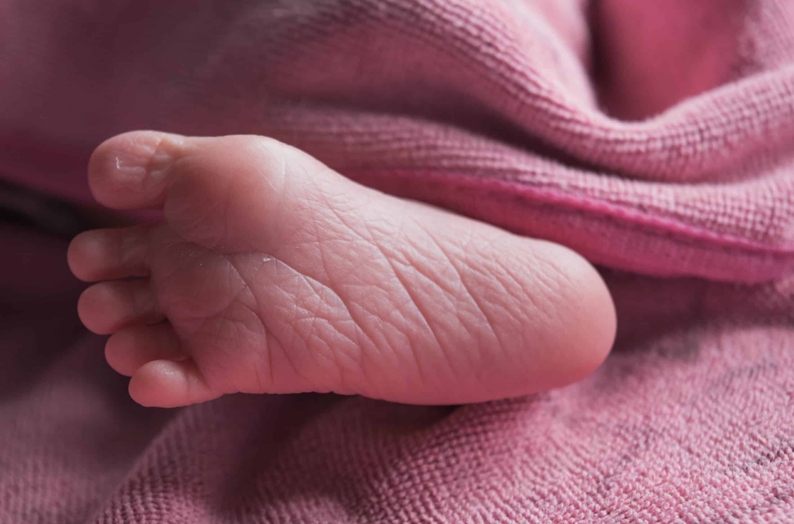 Infant’s foot with creases on the sole.