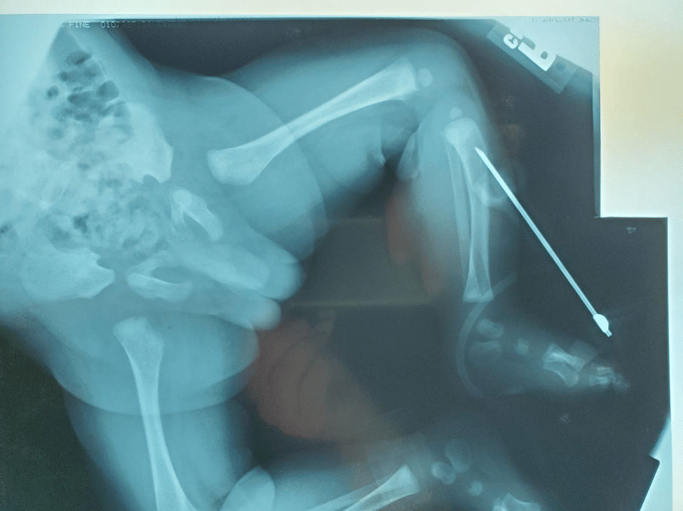 Manual IO Insertion X-ray image of neonate’s lower extremities showing a long needle placed below the knee.
