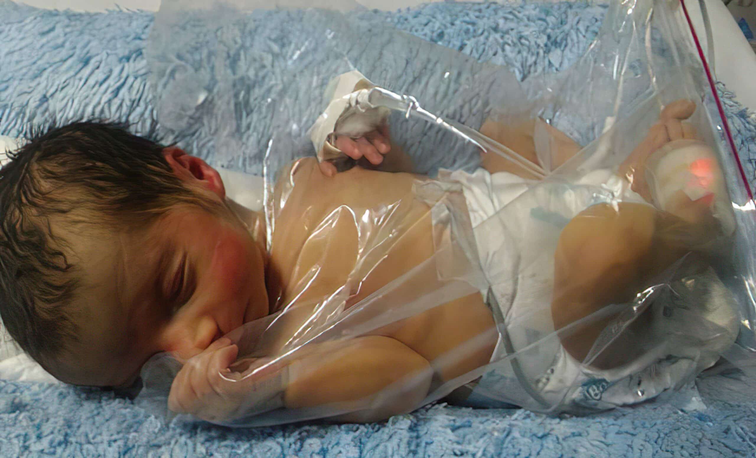 Preterm infant wrapped in polyethylene.