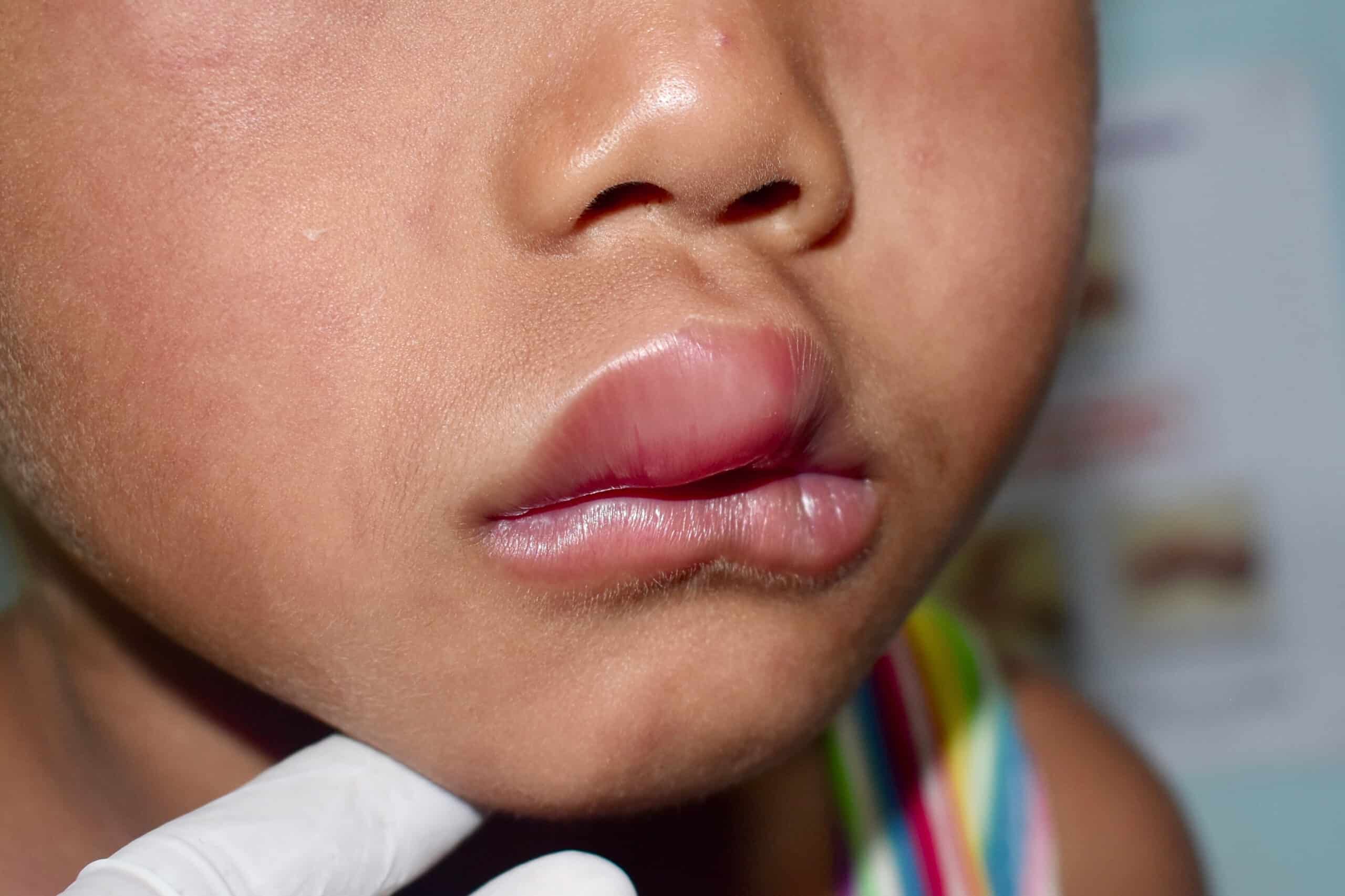 Swollen lips following allergic reaction.