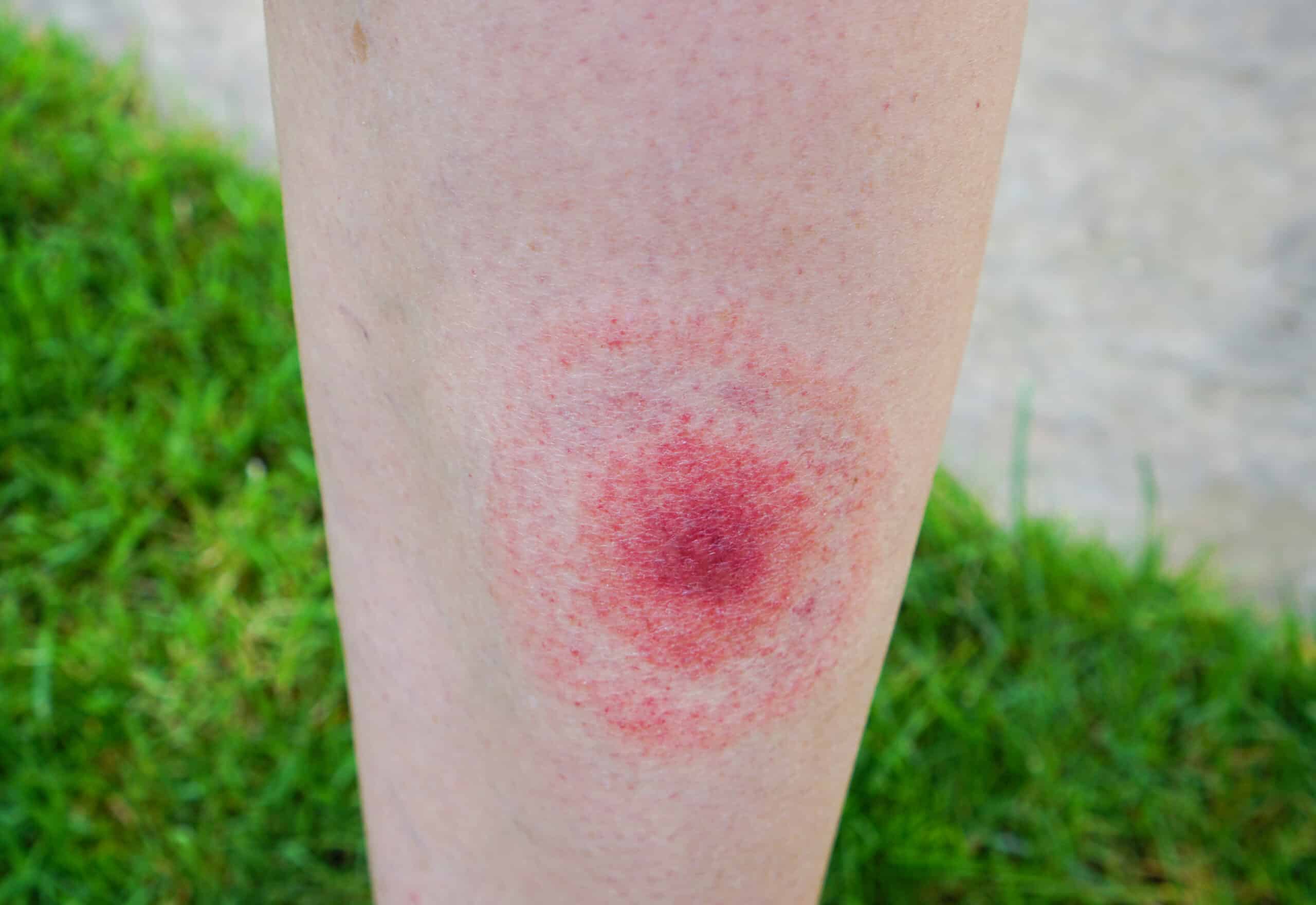 Ticks cause lyme disease and bulls-eye rash.