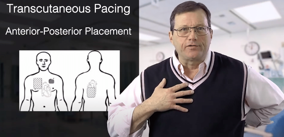Anterior posterior pad placement diagram.