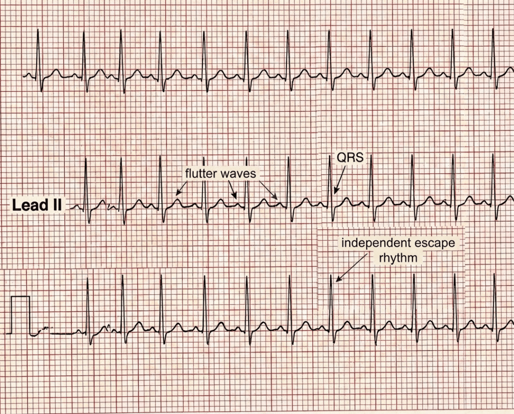 3rd degree heart block variation 3 with independent atrial flutter waves and an escape rhythm showing AV dissociation.