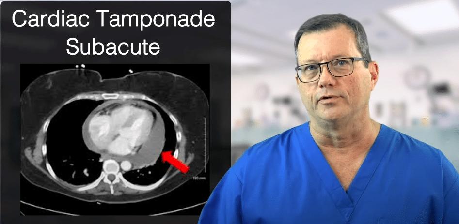 CT scan of cardiac tamponade with fluid build-up in pericardial sac.
