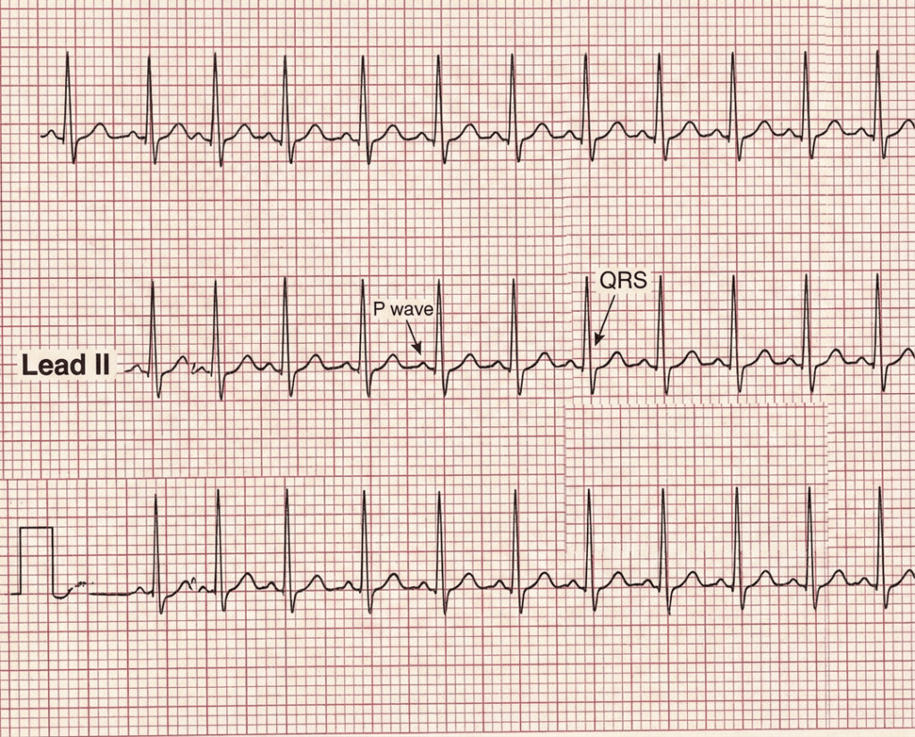 3rd degree heart block variation 1 with AV dissociation and narrow QRS junctional escape rhythm.