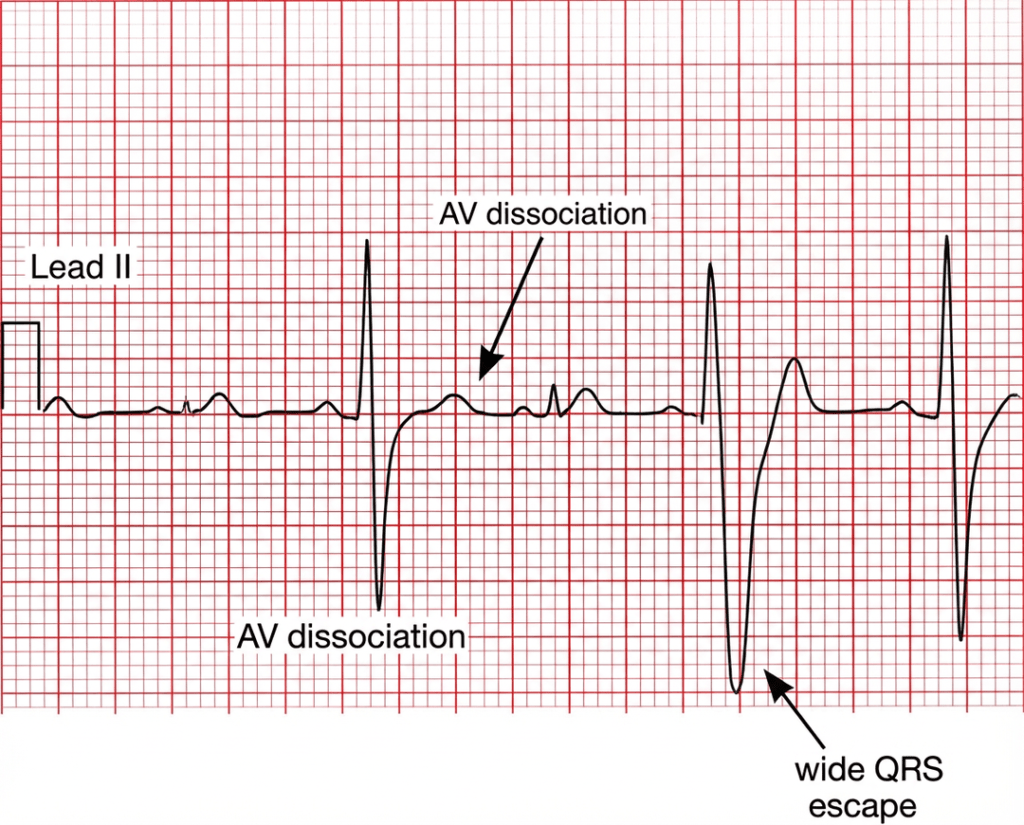 3rd degree heart block variation 2 showing AV dissociation with wide QRS ventricular escape rhythm.