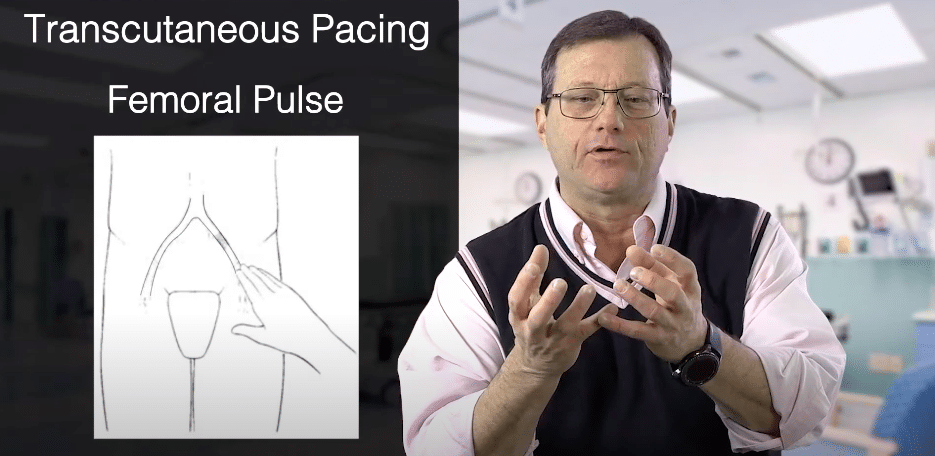 While pacing, find the femoral pulse.