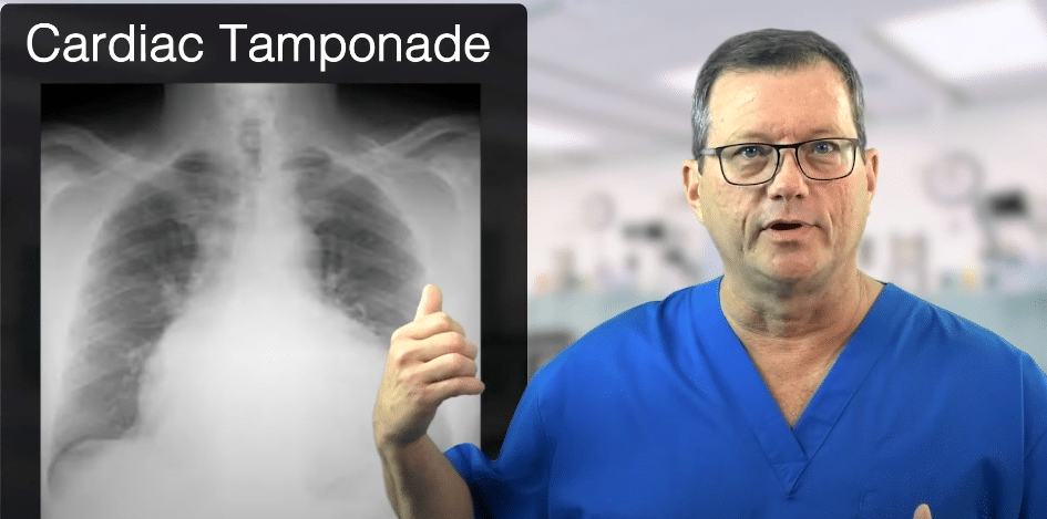 X-ray of an enlarged heart.