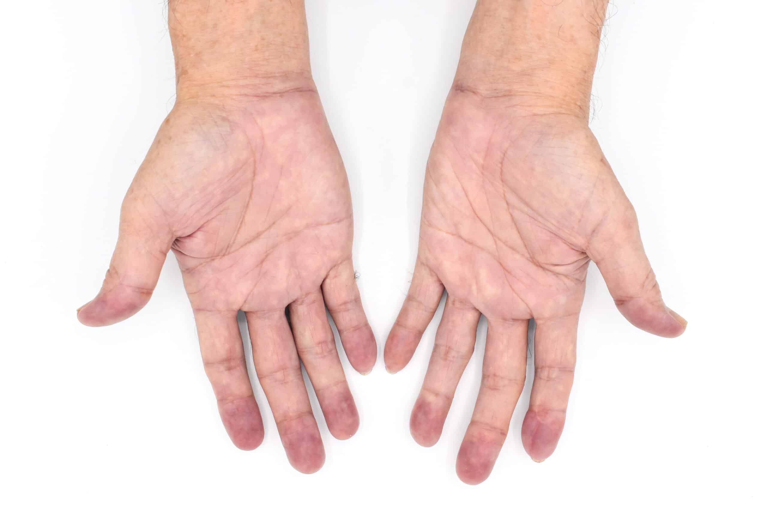 Bluish discoloration of the fingers caused by severe respiratory distress.