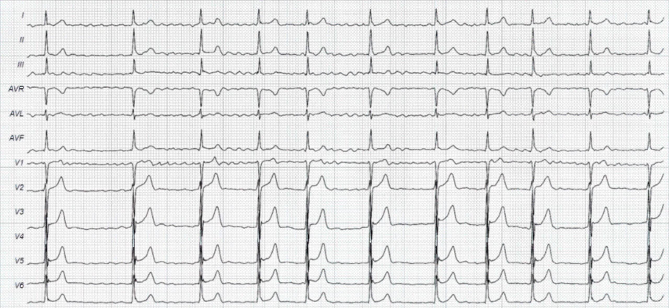 61-year-old asymptomatic woman ECG.